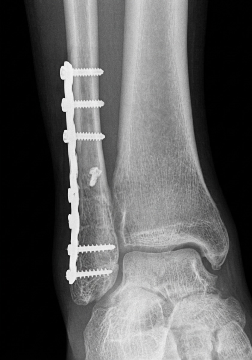 The ankle after surgery — the plate, the screws, and the start of everything